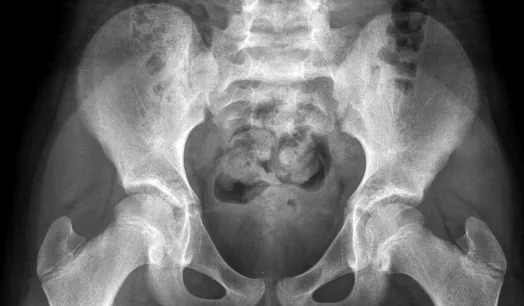 CRÍTICO. Radiografía de una niña sana de 10 años. Los especialistas explican que la pelvis de un niña es demasiado pequeña para permitir el paso de un feto.